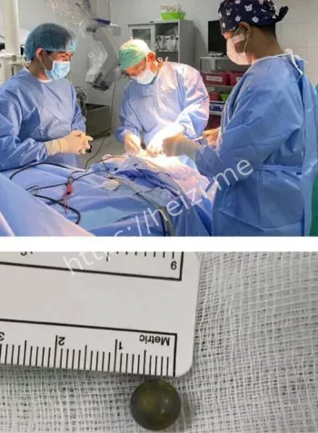 坤塔帕花儿童医院手术成功